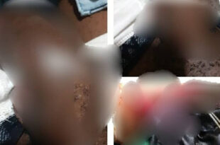 Nigerian man suffers penile fracture while engaging in rigorous sex with his partner (graphic photos)