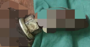 Nigerian man lands in hospital after a metal nut got stuck in his penis while he was masturbating with it (+18 photos)