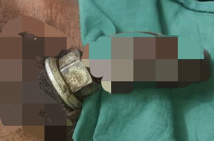 Nigerian man lands in hospital after a metal nut got stuck in his penis while he was masturbating with it (+18 photos)