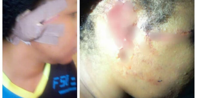 Husband bites off his wife's ear in Niger state.
