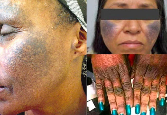 Effects of lightening the skin